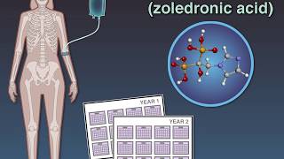 Zoledronate in Osteopenia [upl. by Harriett]