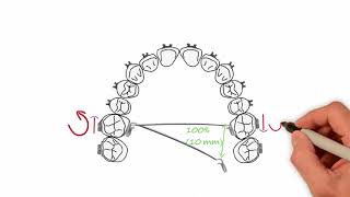 Transpalatal Arch Activations  Essential Biomechanics [upl. by Rammus]