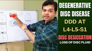 Degenerative Disc Disease DDD L4 L5 L5 S1Disc Desiccation Disc Degeneration Disease Treatment [upl. by Eidoc119]