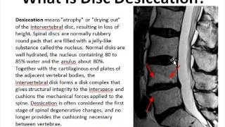 Disc Desiccation [upl. by Aileen]