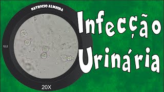 Infecção urinária  Piúria bactérias e muco [upl. by Quintus]