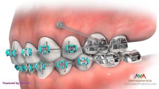 Temporary Anchorage Device or TAD  Orthodontic Appliance [upl. by Kcirad]