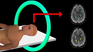 PET Scan  How It Works  Animation [upl. by Narcis]