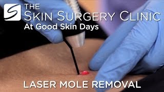 Laser Mole Removal  Watch the Procedure [upl. by Joete]