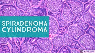 Spiradenoma amp CylindromaSweat Gland Tumor Pathology [upl. by Matti]