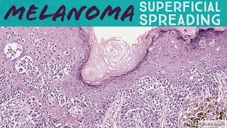 Superficial Spreading Melanoma 5Minute Pathology Pearls [upl. by Ailekat171]