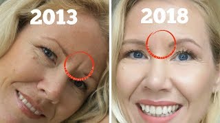 How to get rid of frown lines between eyes  BEAUTY OVER 40 [upl. by Hsejar]