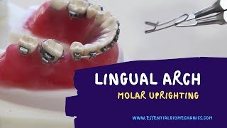 LingualArchforMolarUprighting [upl. by Stimson]