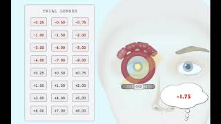 Retinoscopy with trial lenses Minus cylinder [upl. by Eedebez]